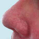 Immediately Following Treatment