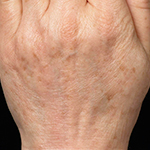 2 Weeks Following 3 Fraxel Treatments for Hand Rejuvenation