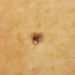 Brown Spots - Before & After