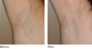 Ultherapy Before + After