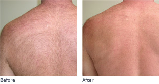 Ulthera Skin Tightening Before + After