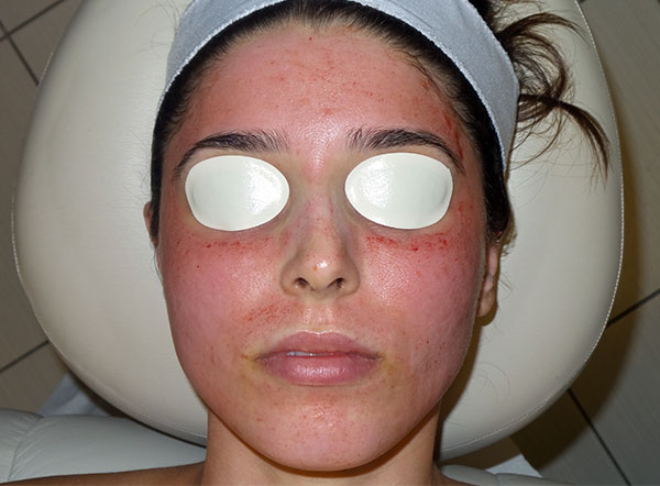 Manhattan Dermatology Patient Microneedling