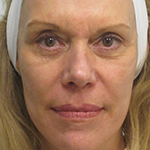 Sculptra Before & After