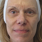 Sculptra Before & After