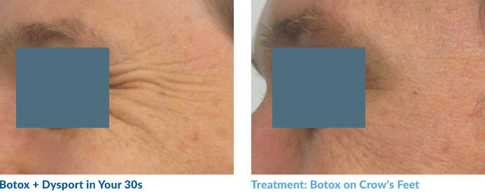This thirtysomething patient has had Botox on his crow's feet. In men, we don’t want to relax the crow’s feet completely. It is natural and attractive for men to have some fine lines.