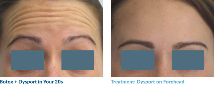 Botox in your 20s—and often 30s—is often able to completely smooth out the lines because these “dynamic” lines have not yet become “static,” or present at rest. Remember: neuromodulators work by relaxing the muscles that contribute to this lines so once the lines become static, relaxing the muscle may not completely remove the line.