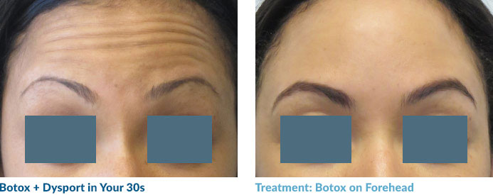 Botox in your 20s—and often 30s—is often able to completely smooth out the lines because these “dynamic” lines have not yet become “static,” or present at rest. Remember: neuromodulators work by relaxing the muscles that contribute to this lines so once the lines become static, relaxing the muscle may not completely remove the line.