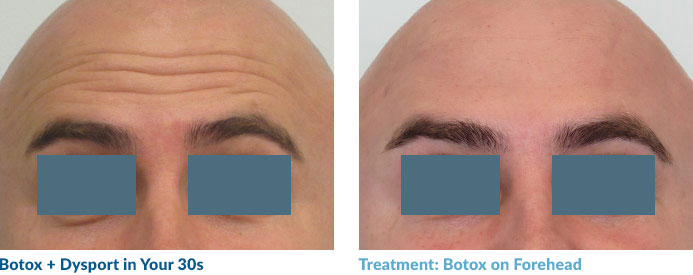 Botox in your 20s—and often 30s—is often able to completely smooth out the lines because these “dynamic” lines have not yet become “static,” or present at rest. Remember: neuromodulators work by relaxing the muscles that contribute to this lines so once the lines become static, relaxing the muscle may not completely remove the line.
