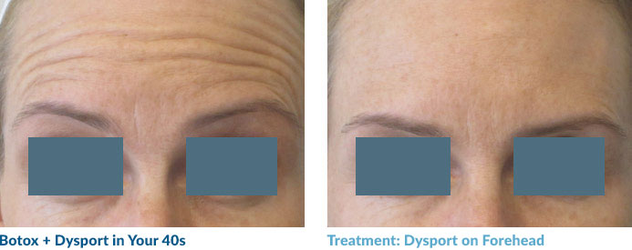 This patient is at risk for dropping and flattening her brow, making her forehead feel heavy and changing her eyebrow shape. However, with careful placement and dosing of dysport, we were able to soften her lines and maintain her forehead function and brow shape. She is always pleased.
