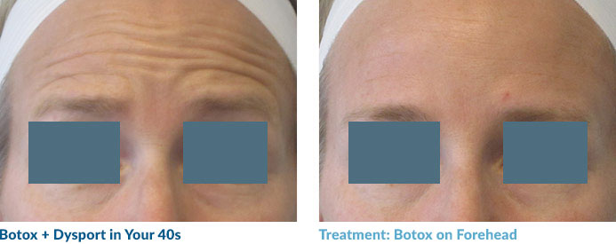 This patient has those pesky “etched-in” lines at rest. Sometimes Botox cannot completely eradicate these lines, but we were able to really soften them. They have slowly started to fade with repeated treatments. She is a good friend of Dr. Magovern’s and is ecstatic with the results.