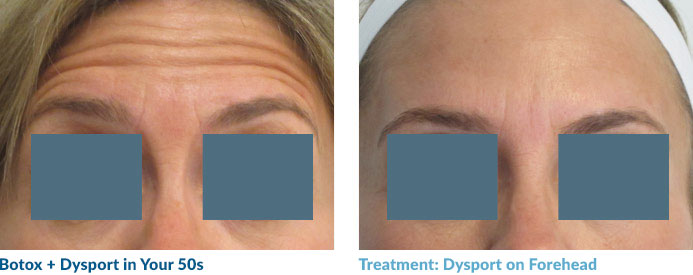 We were able to lift this fiftysomething's medial and lateral brow, allowing for more “lid show” and a more youthful look. Patients in their 40s and 50s love this!