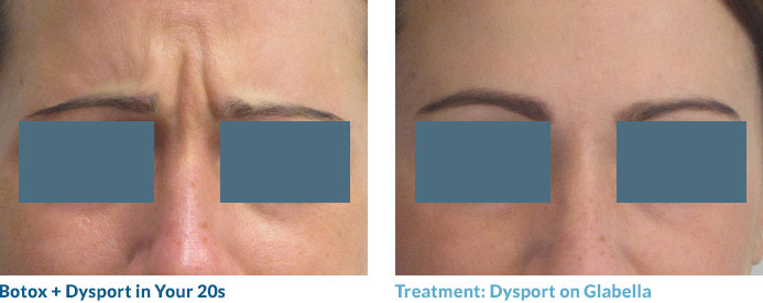 Botox in your 20s—and often 30s—is often able to completely smooth out the lines because these “dynamic” lines have not yet become “static,” or present at rest. Remember: neuromodulators work by relaxing the muscles that contribute to this lines so once the lines become static, relaxing the muscle may not completely remove the line.