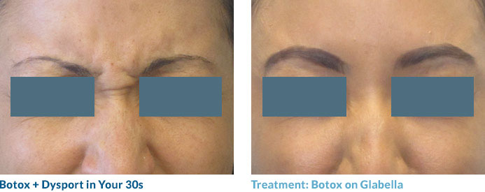 Botox in your 20s—and often 30s—is often able to completely smooth out the lines because these “dynamic” lines have not yet become “static,” or present at rest. Remember: neuromodulators work by relaxing the muscles that contribute to this lines so once the lines become static, relaxing the muscle may not completely remove the line.
