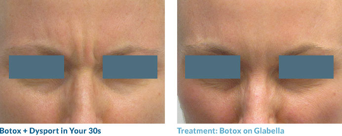 Botox in your 20s—and often 30s—is often able to completely smooth out the lines because these “dynamic” lines have not yet become “static,” or present at rest. Remember: neuromodulators work by relaxing the muscles that contribute to this lines so once the lines become static, relaxing the muscle may not completely remove the line.
