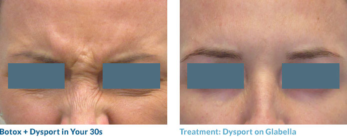 Botox in your 20s—and often 30s—is often able to completely smooth out the lines because these “dynamic” lines have not yet become “static,” or present at rest. Remember: neuromodulators work by relaxing the muscles that contribute to this lines so once the lines become static, relaxing the muscle may not completely remove the line.