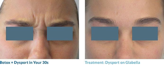 Botox in your 20s—and often 30s—is often able to completely smooth out the lines because these “dynamic” lines have not yet become “static,” or present at rest. Remember: neuromodulators work by relaxing the muscles that contribute to this lines so once the lines become static, relaxing the muscle may not completely remove the line.