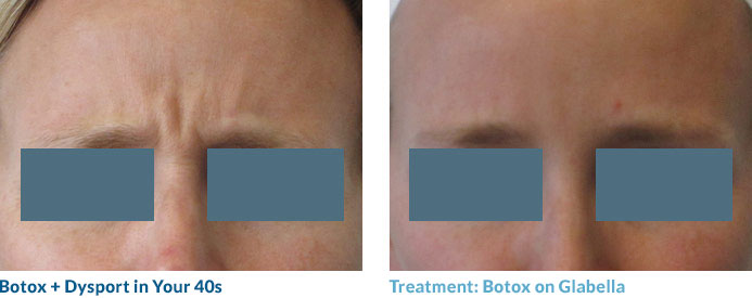 This patient has those pesky “etched-in” lines at rest. Sometimes Botox cannot completely eradicate these lines, but we were able to really soften them. They have slowly started to fade with repeated treatments. She is a good friend of Dr. Magovern’s and is ecstatic with the results.