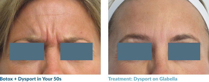 We were able to lift this fiftysomething's medial and lateral brow, allowing for more “lid show” and a more youthful look. Patients in their 40s and 50s love this!