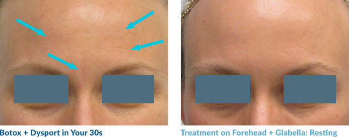 This “resting” image demonstrate that, over the course of a year, using Dysport and a being dedicated to a good home care regimen can fade fine lines, leaving you with a better baseline.