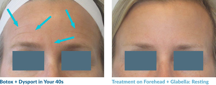 This patient has those pesky “etched-in” lines at rest. Sometimes Botox cannot completely eradicate these lines, but we were able to really soften them. They have slowly started to fade with repeated treatments. She is a good friend of Dr. Magovern’s and is ecstatic with the results.