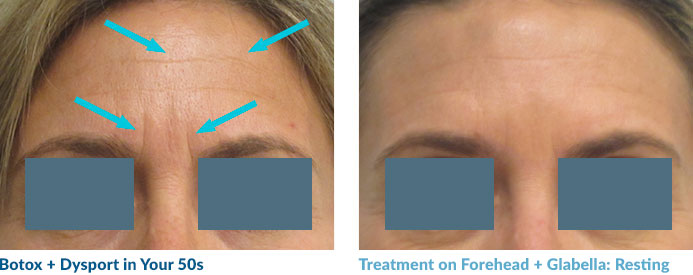 This patient was hesitant to start doing Dysport, and didn’t start until she was in her 50’s. But, it’s never too late to start. She still has some lines at rest, but this actually allows for a very natural, pleasing result. And, like the other patients, the lines are slowly fading with time.