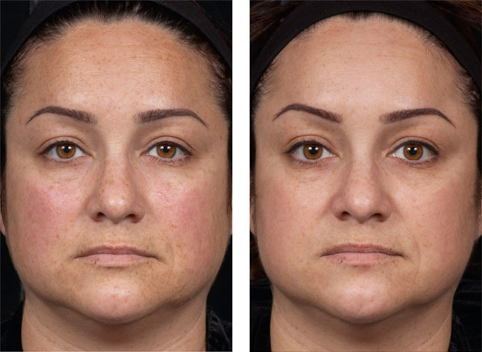 Clear + Brilliant:  1 Month following 6 Treatments