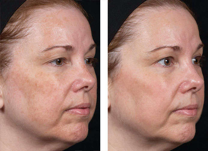 Clear + Brilliant:  1 Month following 6 Treatments