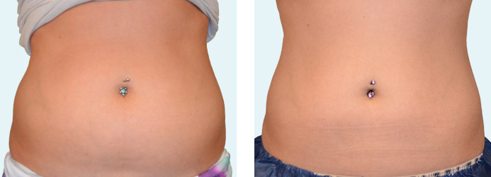 CoolSculpting: 60 days following 1 treatment on love handles and upper + lower abdomen
