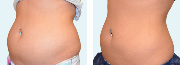 CoolSculpting: 60 days following 1 treatment on love handles and upper + lower abdomen