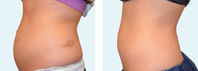 CoolSculpting: 60 days following 1 treatment on love handles and upper + lower abdomen