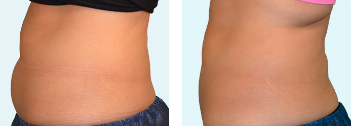 CoolSculpting: 60 days following 2 treatments on love handles and upper + lower abdomen