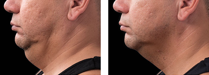 CoolSculpting: 12 weeks following 2 treatments on double chin (submental fat)