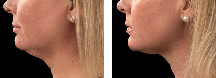 CoolSculpting: 12 weeks following 2 treatments on double chin (submental fat)
