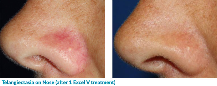 Excel V for Telangiectasia on Nose