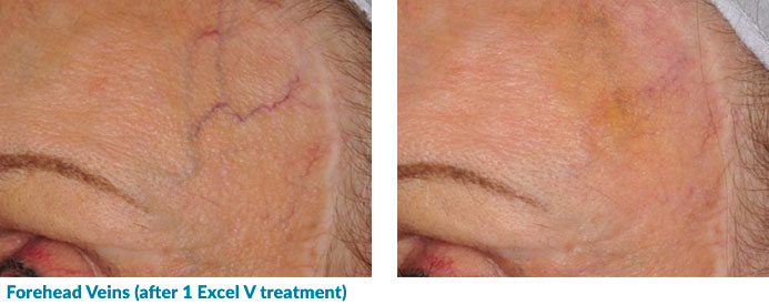 Excel V for Forehead Veins