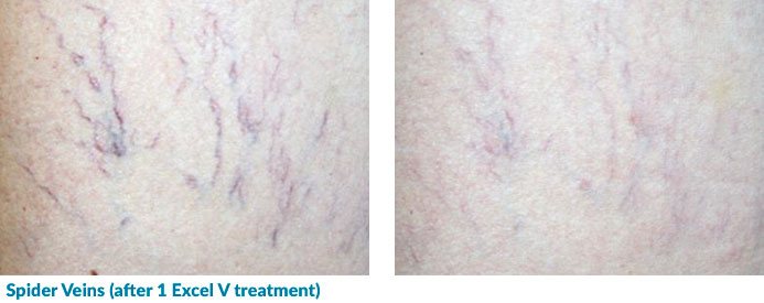 Excel V for Spider Veins