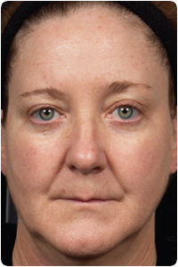1 Month after Treatment