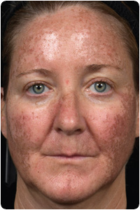 3 Days after Treatment
