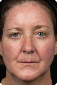 4 Days after Treatment