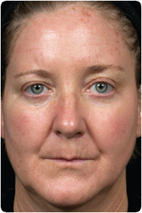 5 Days after Treatment