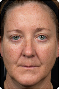 Before Fraxel Treatment