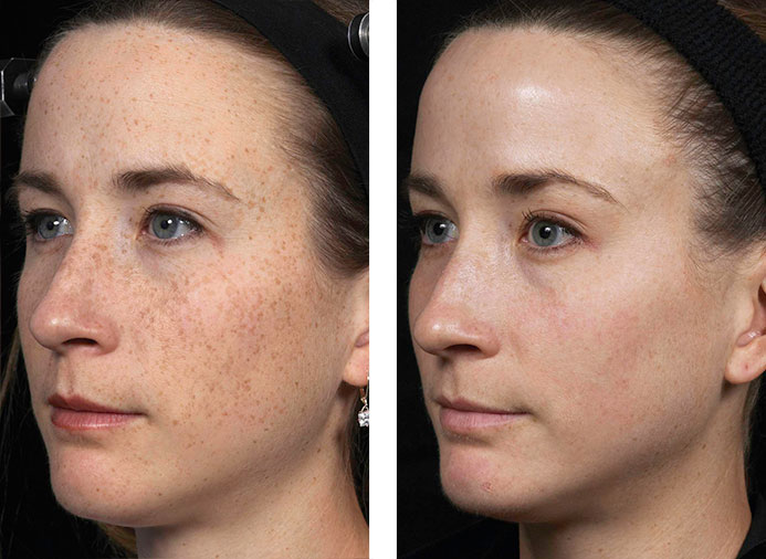 Fraxel 1927: 2 Weeks following 2 Treatments for Freckles