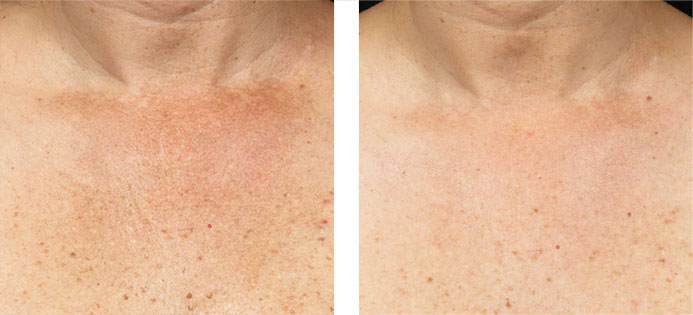 Fraxel 1927: 1 Month following 1 Treatment of Chest for Uneven Pigment and Wrinkles