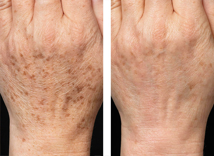 Fraxel 1927: 2 Weeks following 3 Treatments of Hands for Age Spots and Wrinkles
