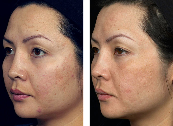 Fraxel 1550: 1 Month following 4 Treatments for Acne Scarring