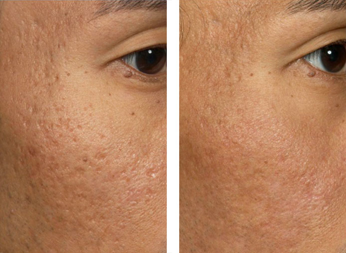 Fraxel 1550: 3 Months following 5 Treatments for Acne Scarring