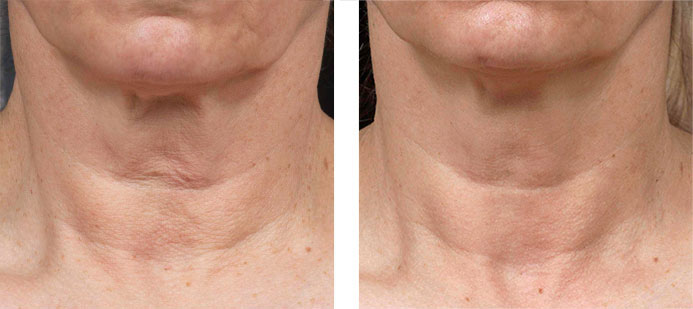 Fraxel 1550: 1 Month following 2 Treatments of Neck for Wrinkles