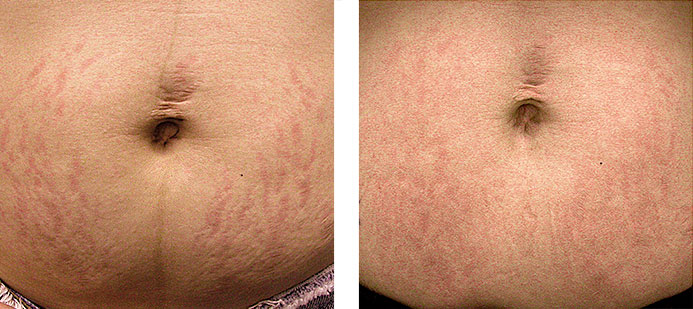 Treated with Fraxel 1550: 1 month following 3 treatments for stretch marks