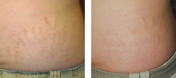 Treated with Fraxel 1550: 1 month following 3 treatments for stretch marks