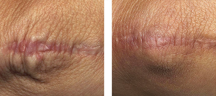 Treated with Fraxel 1550: 5 months following 5 treatments for scarring